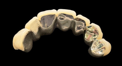 硬質レジン前装冠